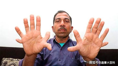 世界指头最多的人,印度木匠有28个手指和脚趾,创吉尼斯世界纪录
