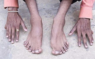 吉尼斯最高纪录,5岁男孩15个手指16个脚趾 组图