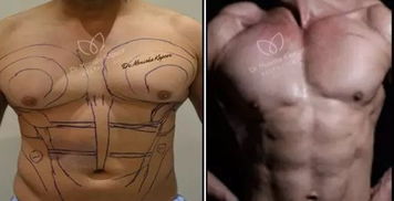 泰国男子通过手术做了六块 人造腹肌 背后真实面目你见过吗