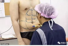 太可怕噜 泰国男子通过手术获得性感六块 人造腹肌 你可以吗