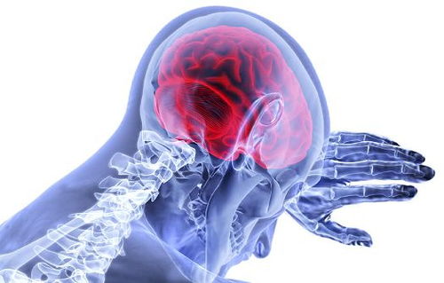 撞到头别大意 剧烈头痛 肢体无力可能是硬脑膜下血肿