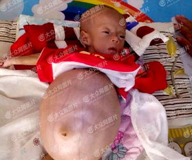 聊城莘县三个月女婴患怪病 肚子大如篮球