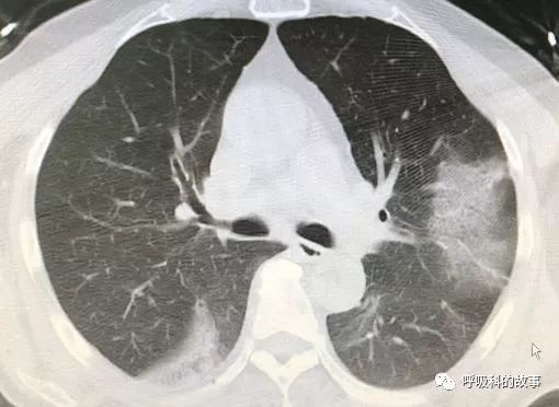新冠鉴别 双肺疑似毛玻璃影,改变体位结果大不同