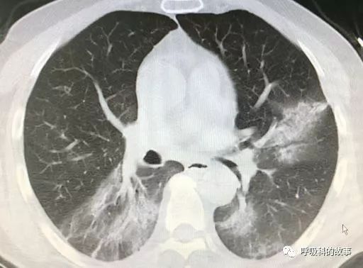 新冠鉴别 双肺疑似毛玻璃影,改变体位结果大不同