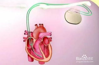 装上心脏起搏器这些事不可做 