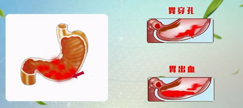 胃穿孔死亡率怎么样