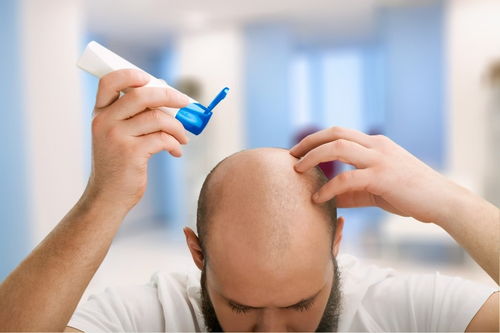 脂溢性脱发,经常洗头能改善吗 如此做或 弊大于利