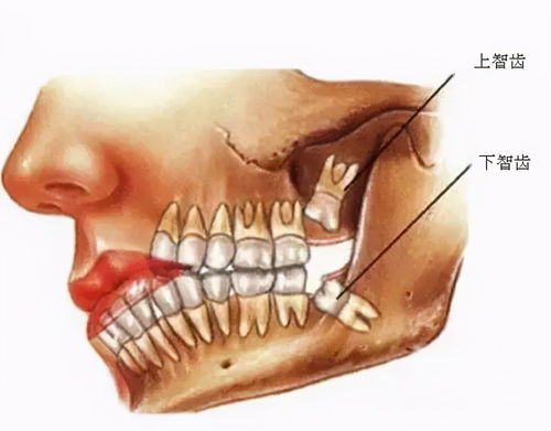 智齿不痛就不拔 拔完智齿能瘦脸 你对它可能一无所知