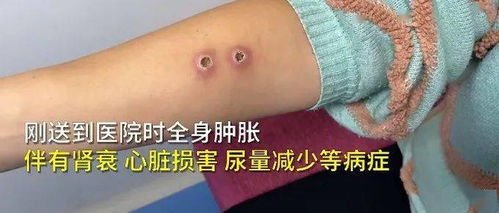 西安丨可怕 一家三口上山采板栗被胡蜂蛰伤进了ICU 父亲竟被蜇了一百多处