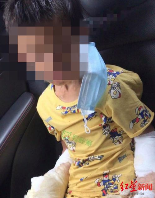 广东7岁男童遭父亲烟头烫伤,男童姑姑 生下第二孩后,弟弟变了 
