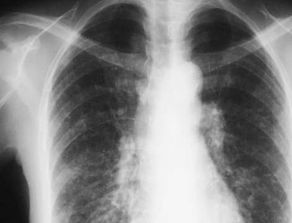 肺癌晚期治疗怎么减轻痛苦