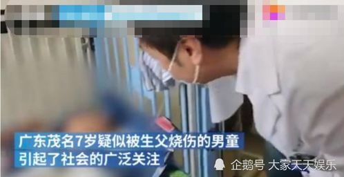 疑遭生父烫伤男童切除部分手指,他爸为何如此残忍