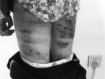 安徽六安市又现虐童案 12岁男童因弄丢钱被母亲用电线抽打 图