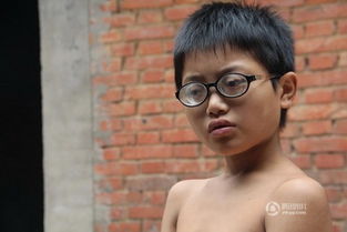 河南11岁男童裸眼2000多度 镜片比啤酒瓶厚 