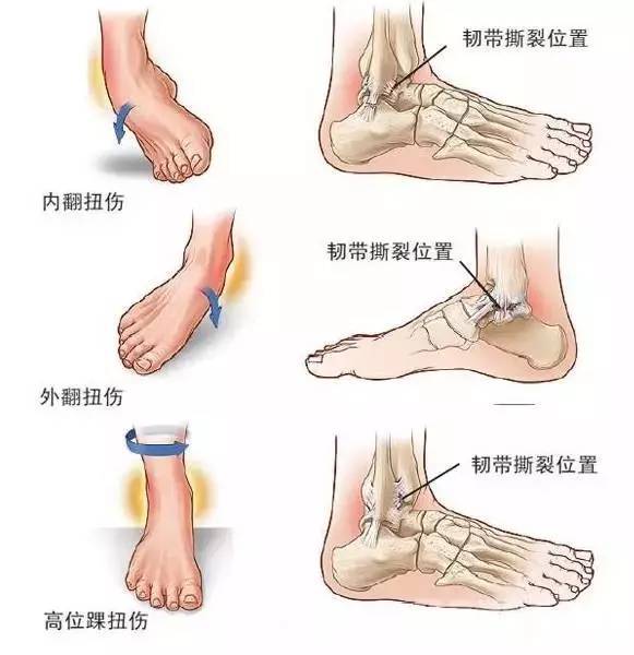 运动中脚踝扭伤,合理的康复方法让你告别习惯性崴脚 