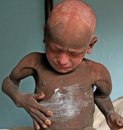 印度男孩患怪病,全球得此病者不到10人,身体发生巨大转变
