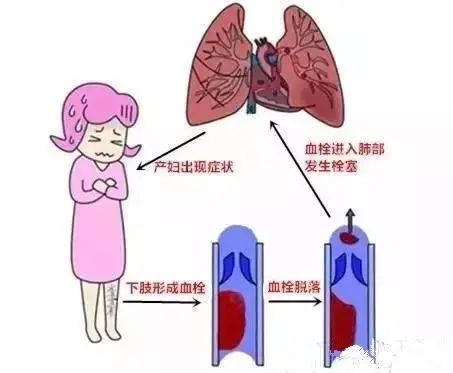 产妇心脏骤停3次抢救5小时 产后肺栓塞怎么来的