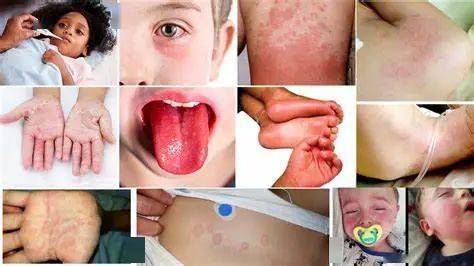 美国数百名儿童感染怪病,与新冠相关 其免疫系统严重受损...