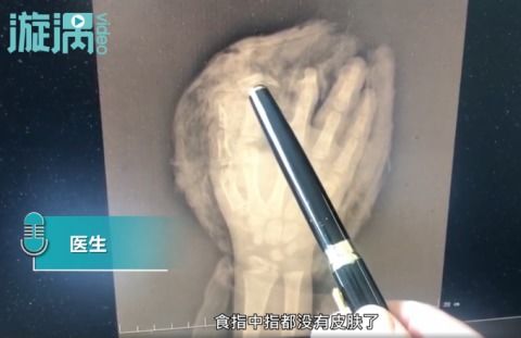 长沙8岁男童捡烟花燃放手被炸烂,骨头外露,画面令人心痛