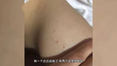 幼儿园3岁女童身上现29处针眼 至今仍未得到学校回复