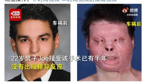 全球首例成功换脸换手手术 美国男子换掉了自己的整张脸和双手