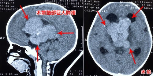 三博脑科 2岁宝宝颅内长8厘米巨大脑肿瘤 奋战17小时成功摘瘤