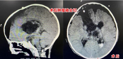 三博脑科 2岁宝宝颅内长8厘米巨大脑肿瘤 奋战17小时成功摘瘤