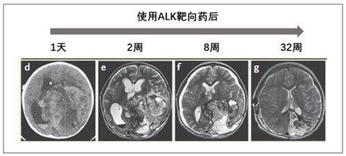 奇迹 肺癌靶向药竟然救活了3岁脑瘤男孩