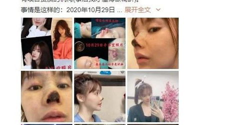 长沙女演员自曝整形失败致鼻头坏死 官方通报处理结果