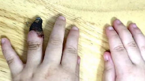 痛心 湖北3岁女孩手指受伤,奶奶错误包扎致手指坏死被截肢