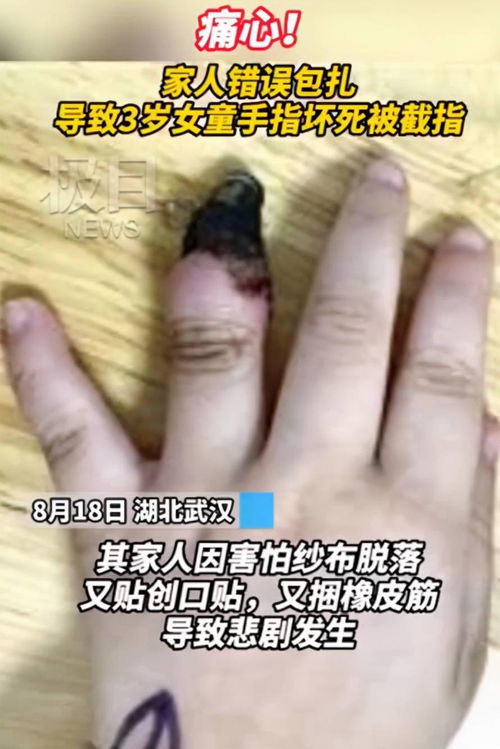 3岁女宝手指受伤,奶奶误用创可贴致残疾,结局太痛心