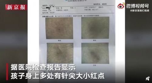 深圳一幼儿园4岁幼童疑遭扎针目前正在调查中 热点跟踪