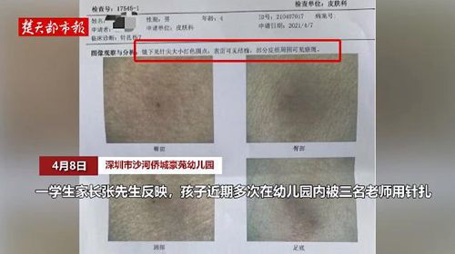 深圳一幼儿园4岁幼童疑遭扎针 教育局已介入调查