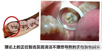 智齿长成什么样,就应该拔掉了