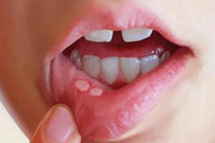 口腔溃疡者治愈后,反馈出最有效的3个小方法,好用不反复 