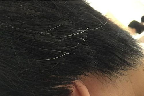 白发长在不同部位,暗示了不同的毛病 哪个地方长白发更危险