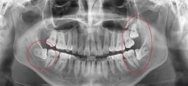 拔智齿后遗症太多了_健康频道 智齿拔了要痛多久