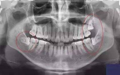 什么是智齿 对人体有什么危害 智齿是否都要拔除