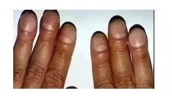 指甲垂直纹多为癌症 你不能判断你得了癌症 指甲垂直竖纹