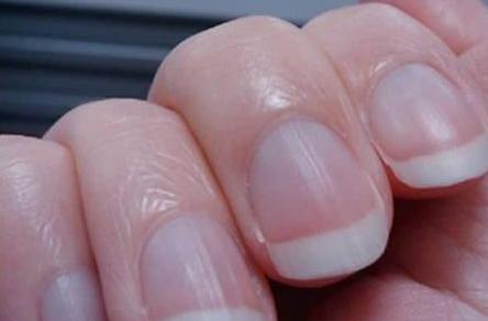 指甲有竖纹,是身体的什么信号