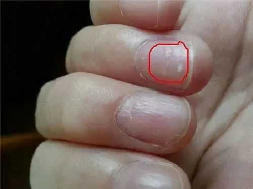 指甲有竖纹 横纹 淤青 月牙都代表什么 教你读懂指甲的信号