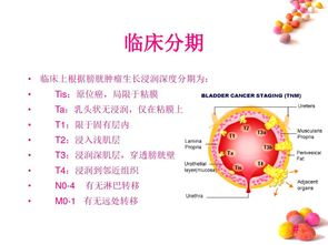 成都御生堂治膀胱癌好吗 寻因辨证,分型治疗效果好