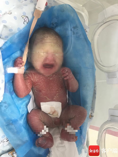 海南一宝宝出生全身为羊皮纸样 是罕见的 火棉胶婴儿 