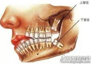 拔智齿后悔死了,这4种情况下的智齿不用拔 拔了就后悔