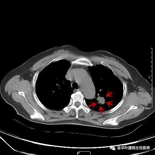 我错了 一例误诊为肺癌病例的医生反思