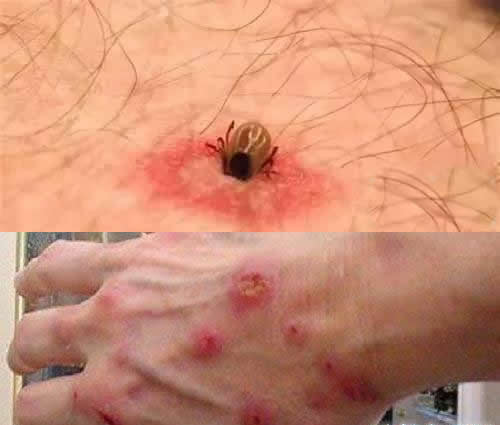 蜱咬伤后的伤口图 被蜱虫要求后,不要太惊慌 蜱虫咬伤后的伤口和症状