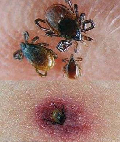 蜱虫叮咬后伤口图片 被蜱虫叮咬后的正确处理方法 