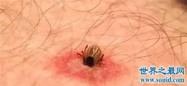 蜱虫叮咬后的伤口图片,如何预防蜱虫 2 