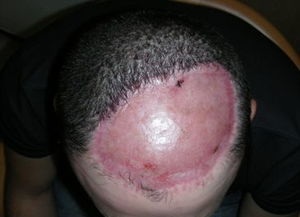英国男子切除头部脂肪瘤失去大量头皮和秃顶