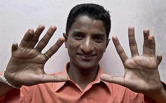手指最多的人 印度男子有28根手指和脚趾